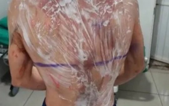 Cerca de 20 alunos sofrem queimaduras após trote em universidade federal