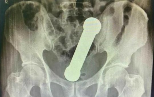 Médicos removem haltere de 2kg do ânus de homem; caso aconteceu em Manaus