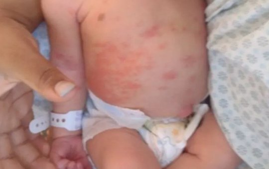 Bebês ficam empolados e famílias denunciam falta de climatização em maternidade