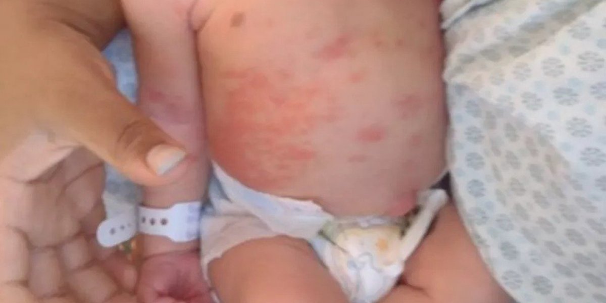 Bebês ficam empolados e famílias denunciam falta de climatização em maternidade