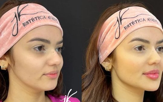 Eslovênia desembolsa R$ 70 mil em procedimentos estéticos