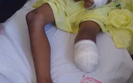 Criança tem perna amputada após cair de ônibus escolar