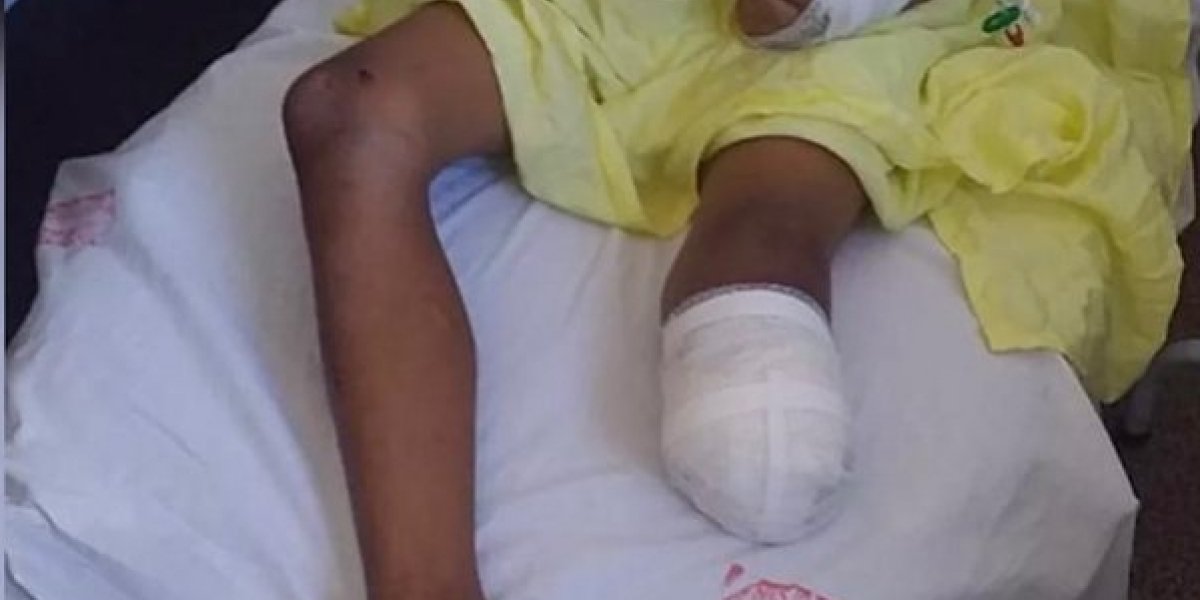 Criança tem perna amputada após cair de ônibus escolar