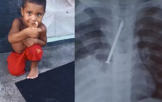 Criança de 3 anos morre após passar um ano com prego no pulmão na Bahia