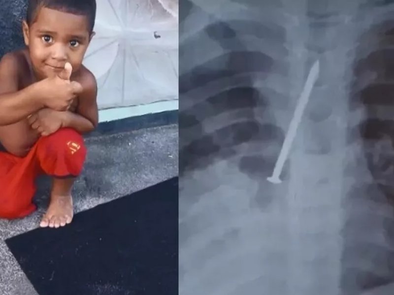 Criança de 3 anos morre após passar um ano com prego no pulmão na Bahia