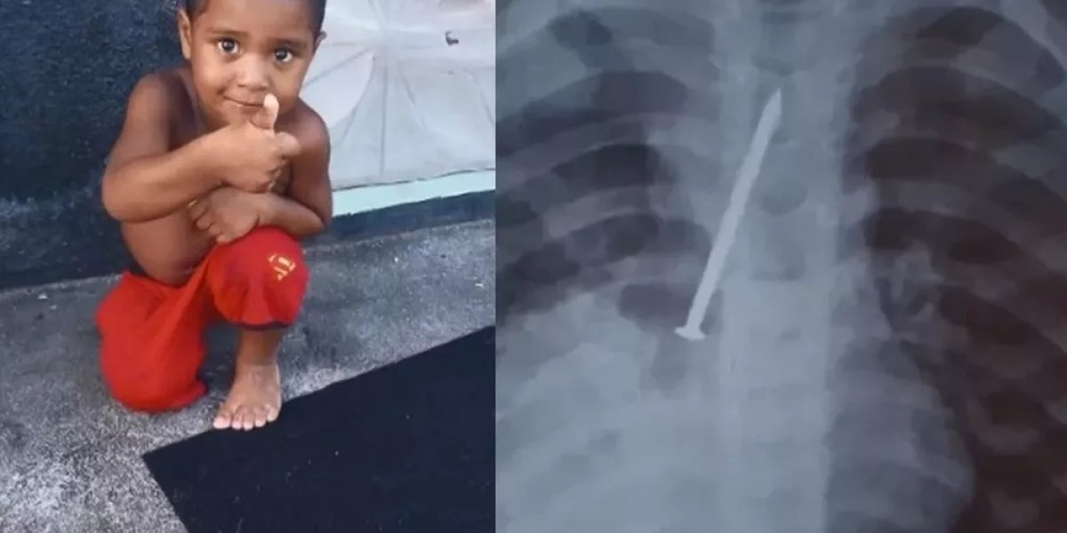 Criança de 3 anos morre após passar um ano com prego no pulmão na Bahia