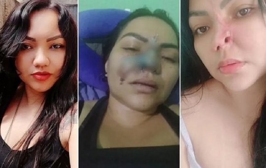 "É assustador", diz mulher que perdeu parte do nariz em procedimento estético