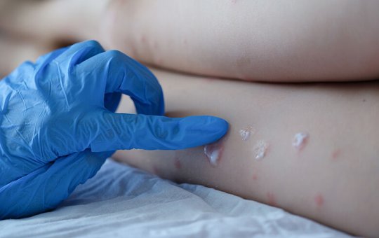 Brasil já tem mais de 200 casos confirmados de varíola dos macacos