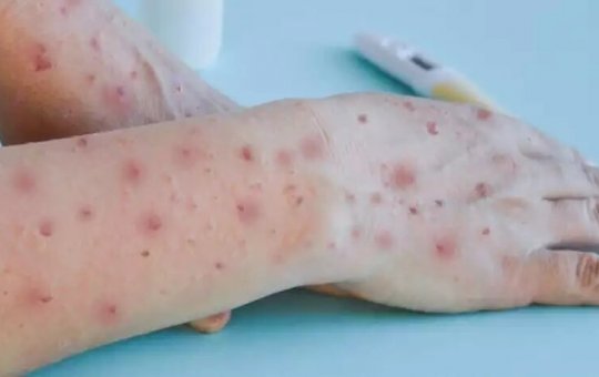 SMS emite orientações após primeiro caso de varíola do macaco em Salvador