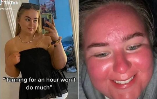 Mulher aparece com rosto inchado após onda de calor atingir o Reino Unido