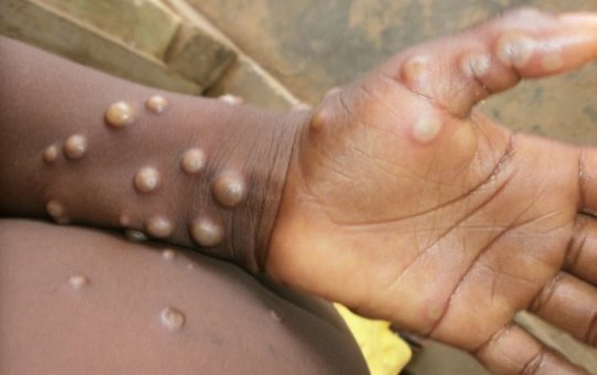 Varíola dos macacos: Infectologista explica sobre diferentes aspectos da doença