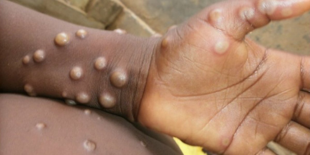 Varíola dos macacos: Infectologista explica sobre diferentes aspectos da doença