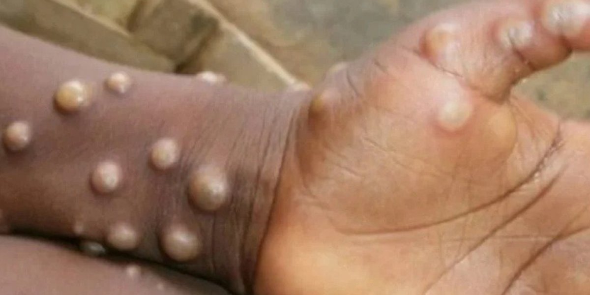 Número de casos suspeitos de varíola dos macacos na Bahia sobe para 23