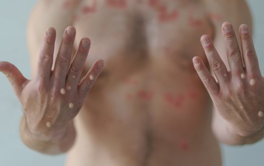 Varíola do macaco: Salvador confirma mais dois casos nesta segunda (25)