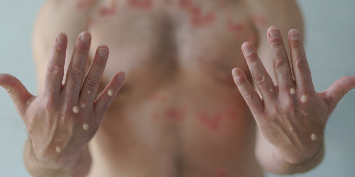 Varíola do macaco: Salvador confirma mais dois casos nesta segunda (25)