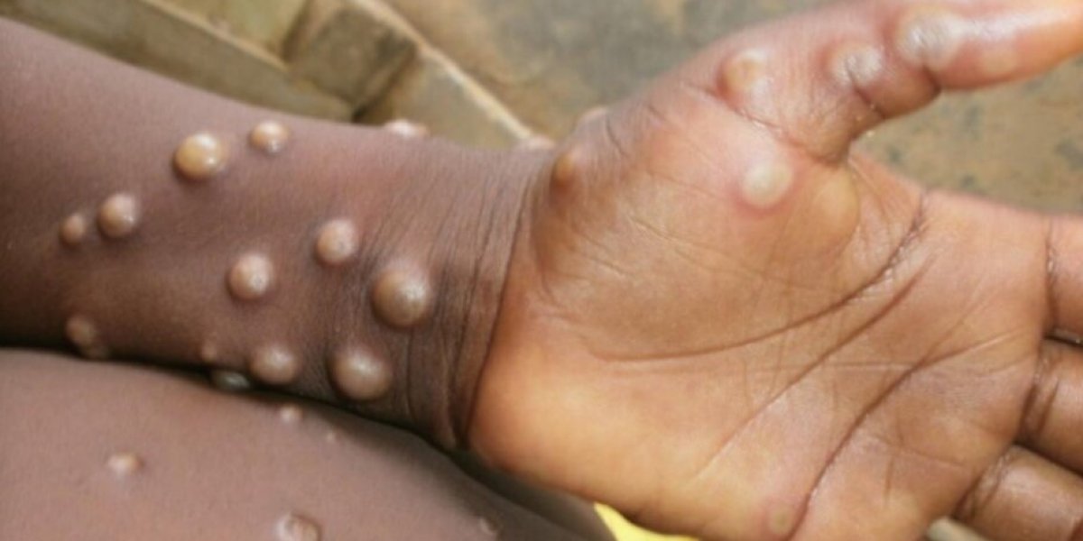 Após revisão de laudos, caso de varíola dos macacos em Ilhéus é descartado