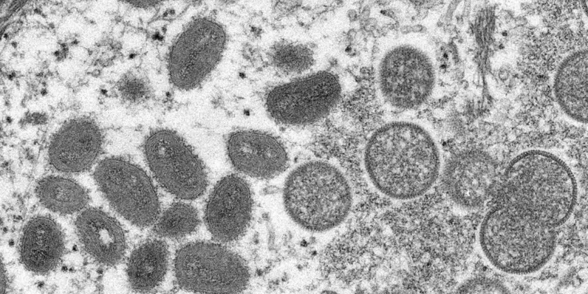 Primeira vítima da varíola dos macacos no Brasil tinha condições clínicas graves
