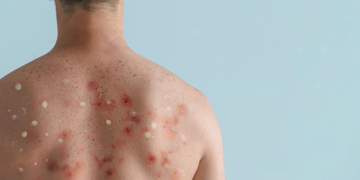 Bahia tem três casos de varíola dos macaco no interior