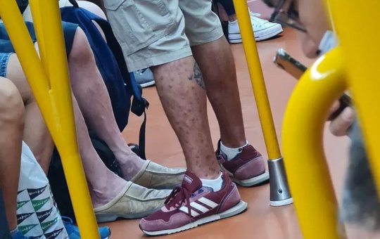 Médico flagra homem infectado com varíola dos macacos em metrô