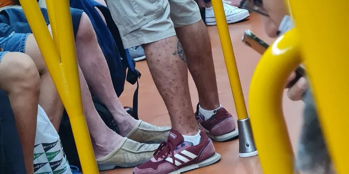 Médico flagra homem infectado com varíola dos macacos em metrô
