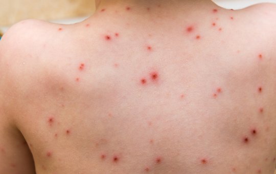 Varíola dos macacos: Ministro diz que Brasil terá antiviral para tratar doença