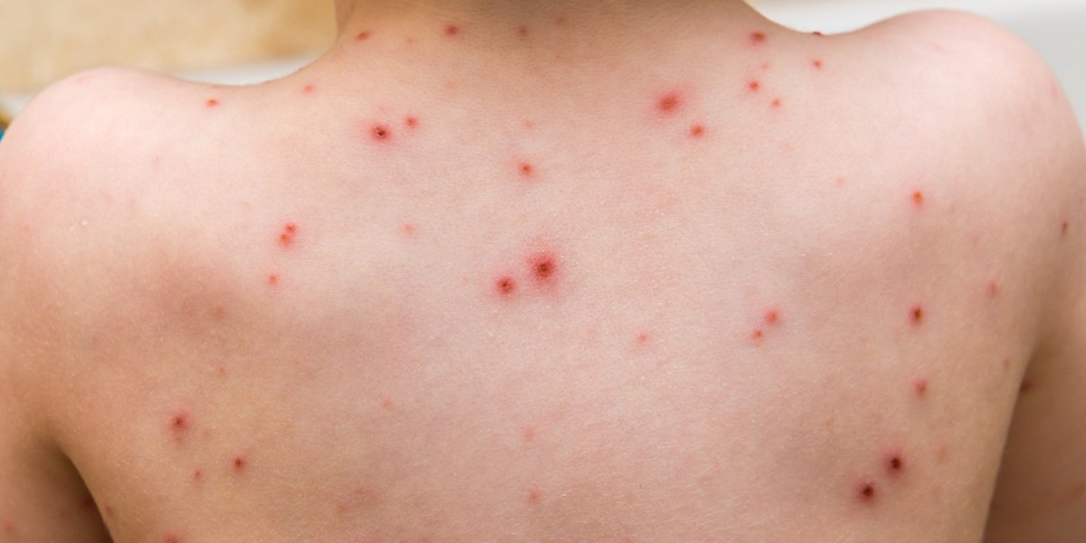 Varíola dos macacos: Ministro diz que Brasil terá antiviral para tratar doença