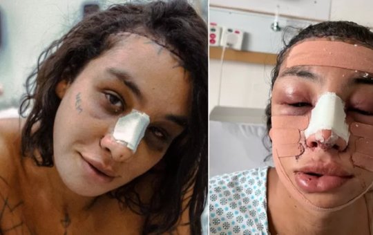 Linn da Quebrada mostra resultado após cirurgia de afirmação de gênero