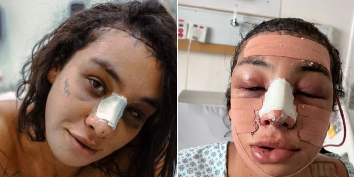 Linn da Quebrada mostra resultado após cirurgia de afirmação de gênero