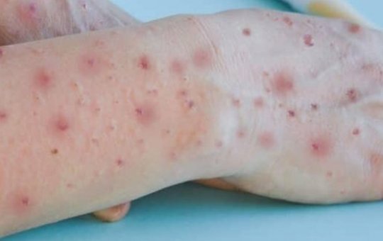 Saúde apresenta plano de contingência contra varíola dos macacos em Salvador