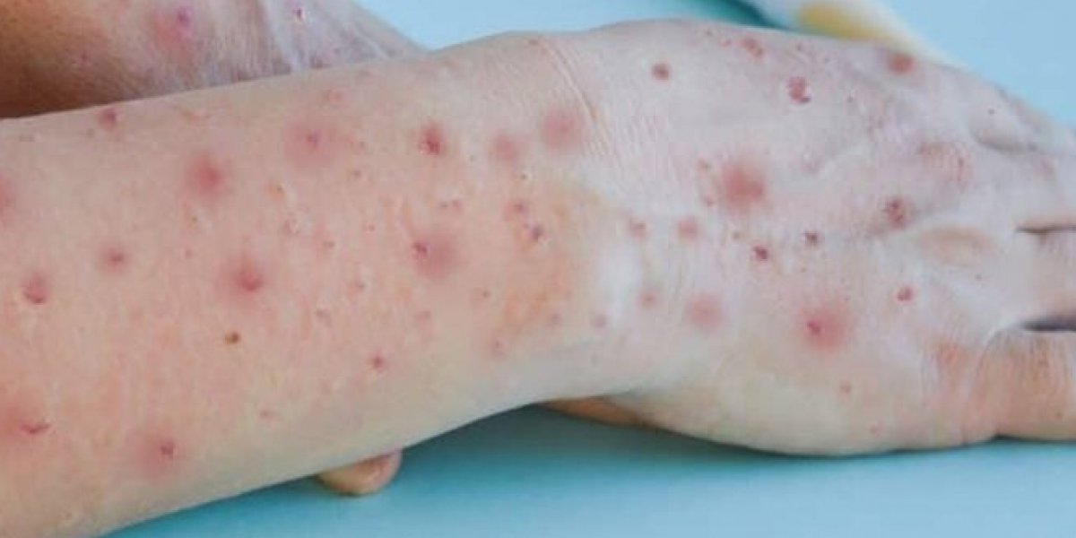 Saúde apresenta plano de contingência contra varíola dos macacos em Salvador