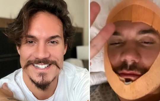 Ex-BBB Eliezer faz transplantes de barba e cabelo; Saiba o valor