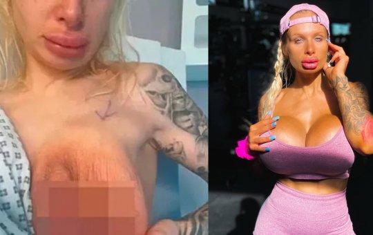 Atriz divulga imagens de prótese mamária estourada, após passar por cirurgia