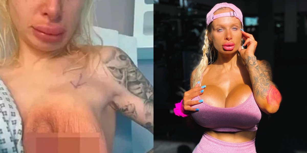 Atriz divulga imagens de prótese mamária estourada, após passar por cirurgia