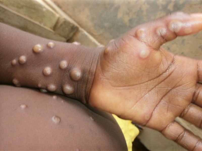 Novo caso de varíola dos macacos é registrado em Salvador