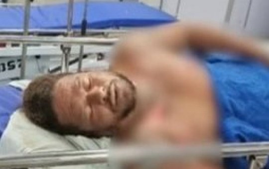 Acusado de atear fogo em companheira na Boca do Rio morre no HGE