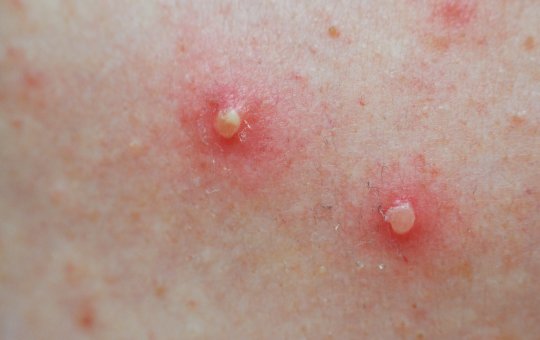 Bahia chega a 33 casos de varíola dos macacos