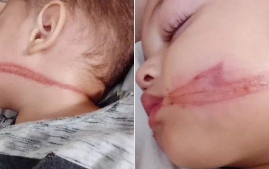 Bebês gêmeos são atingidos por fios soltos e ficam com rostos marcados