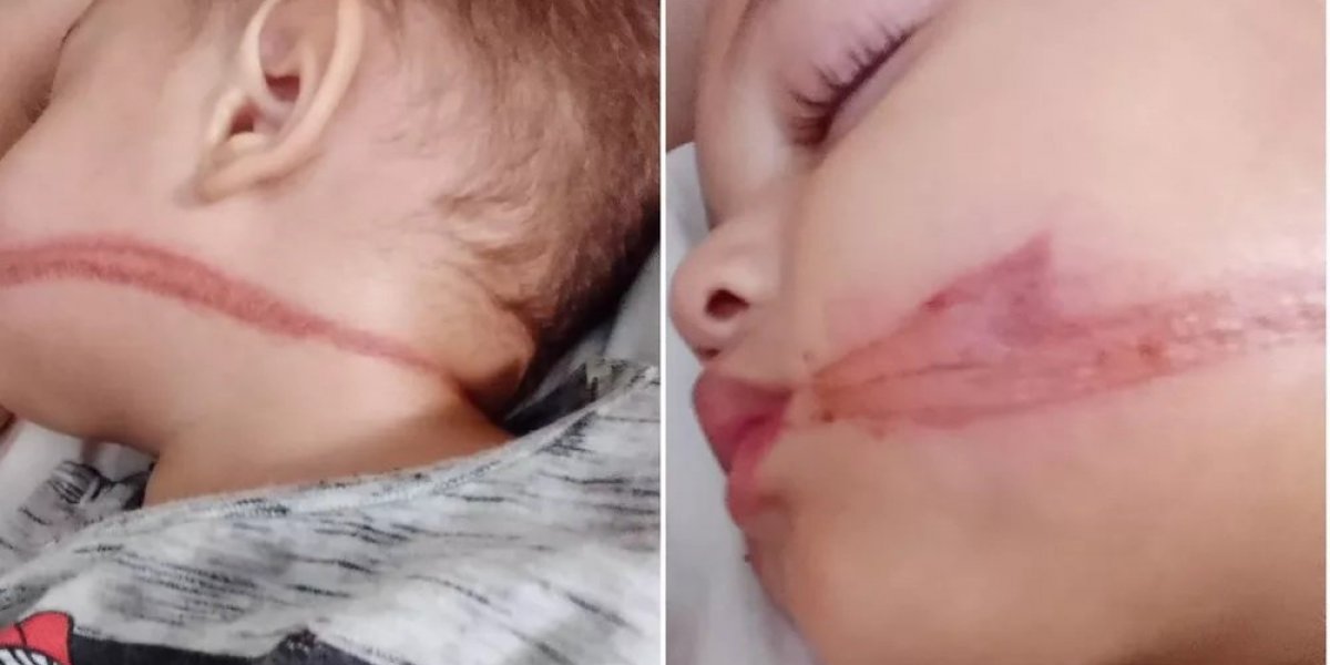 Bebês gêmeos são atingidos por fios soltos e ficam com rostos marcados