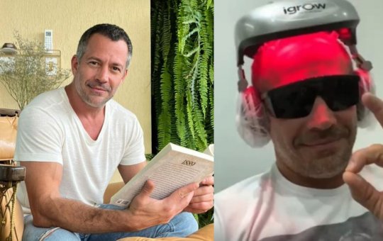 Malvino Salvador revela antes e depois de seu implante capilar