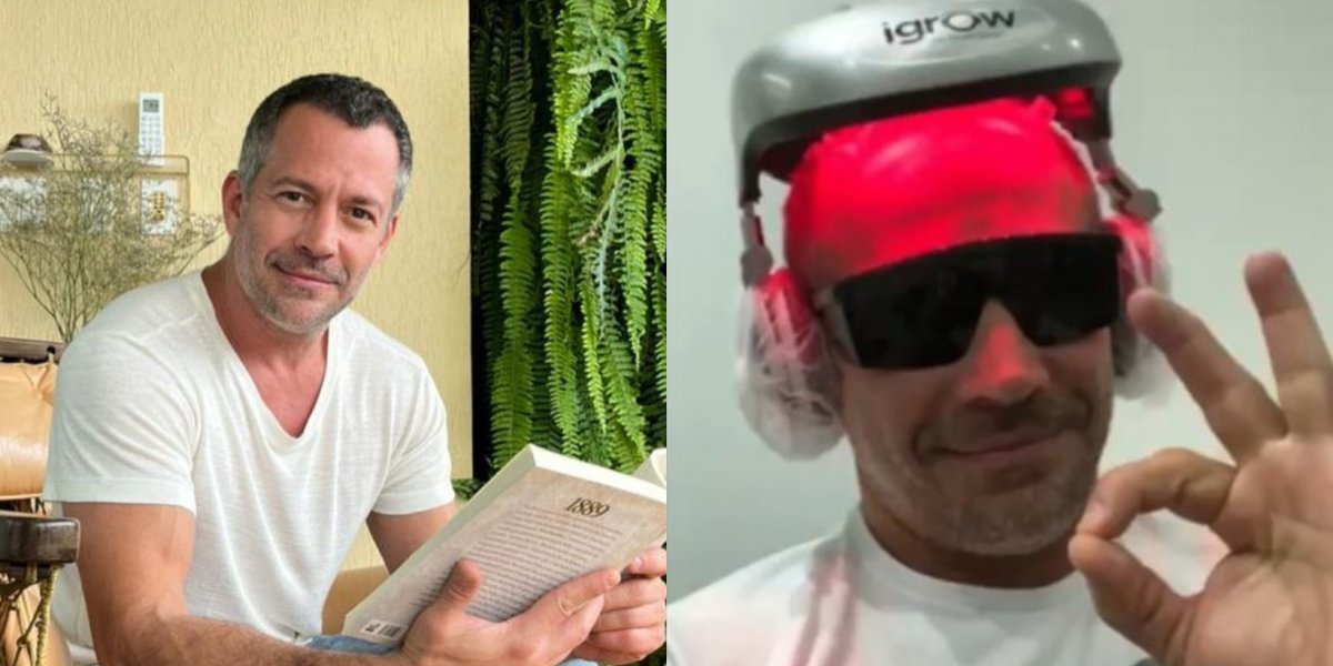 Malvino Salvador revela antes e depois de seu implante capilar