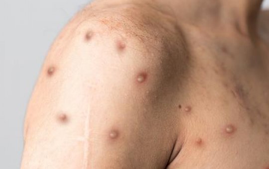 Italiano testa positivo para Covid, HIV e varíola dos macacos