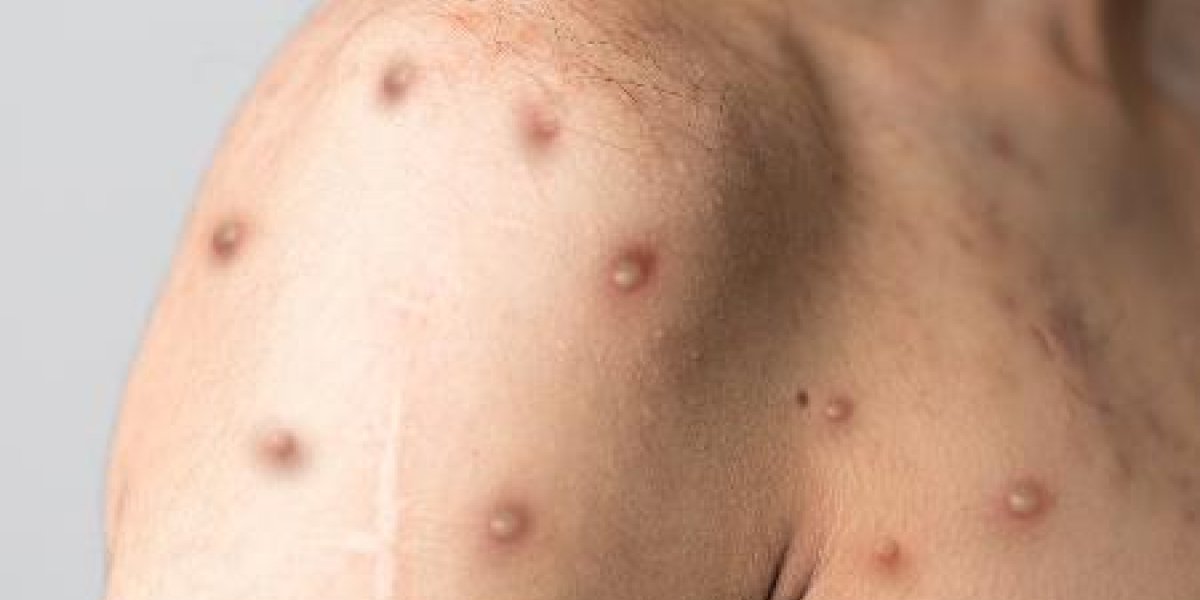 Italiano testa positivo para Covid, HIV e varíola dos macacos
