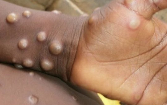 Anvisa autoriza vacina e antiviral contra o vírus da varíola dos macacos