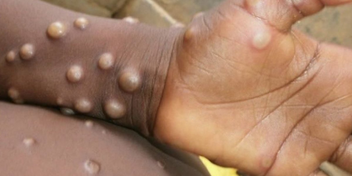 Anvisa autoriza vacina e antiviral contra o vírus da varíola dos macacos