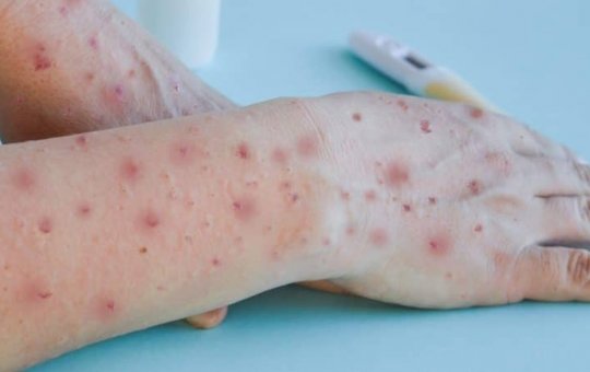 Bahia chega a 45 casos confirmados de Varíola dos Macacos