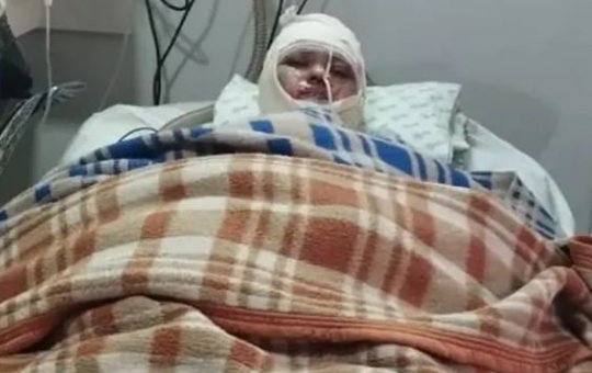 Mulher acorda do coma, conta que marido ateou fogo nela e depois morre
