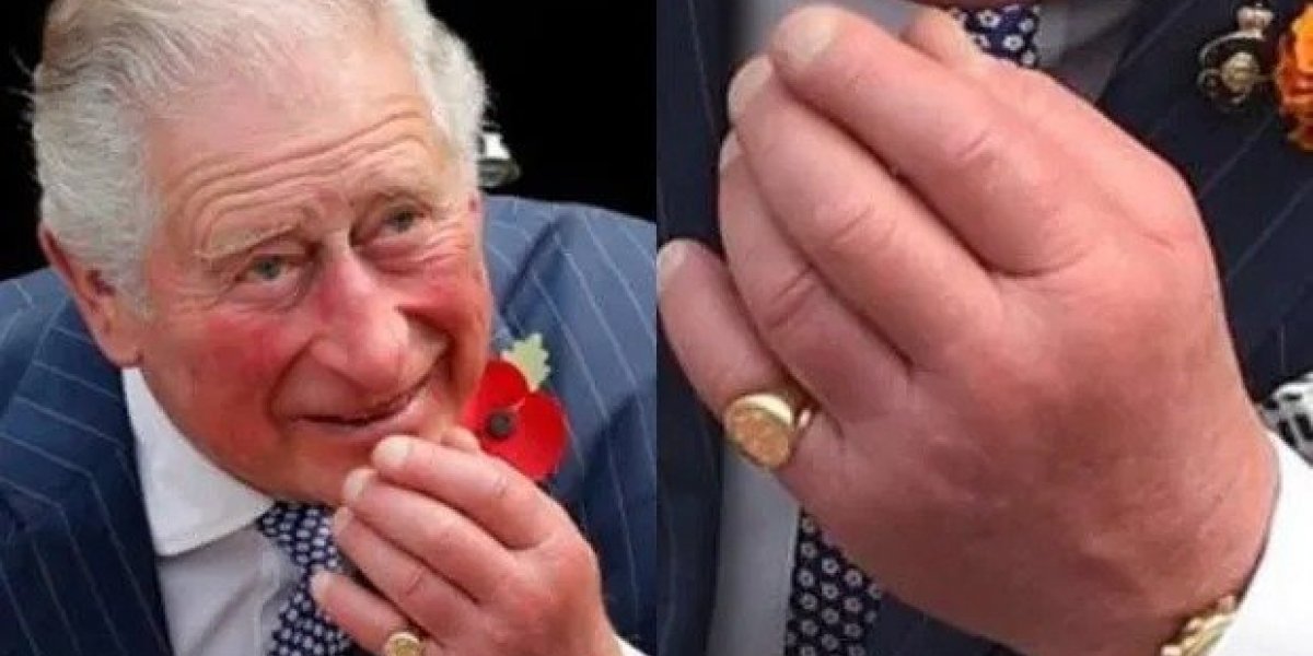 Médico explica motivo do inchaço dos 'dedos de salsicha' do Rei Charles: entenda