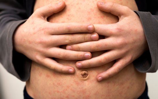 Ministério da Saúde promove o Dia S para reforçar ações contra o sarampo