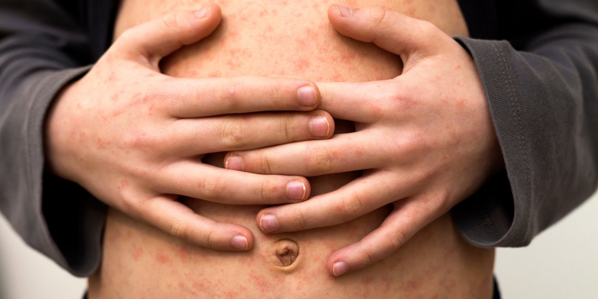 Ministério da Saúde promove o Dia S para reforçar ações contra o sarampo