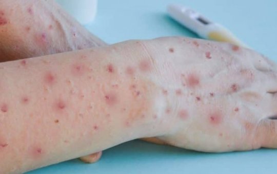 6º Caso de óbito por Varíola dos Macacos é confirmado no Brasil